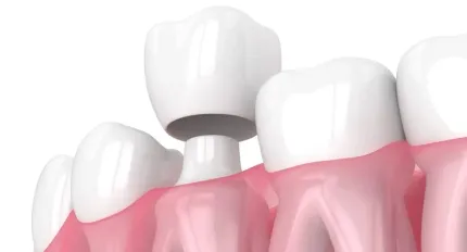 All-Ceramic Zirconia Crowns